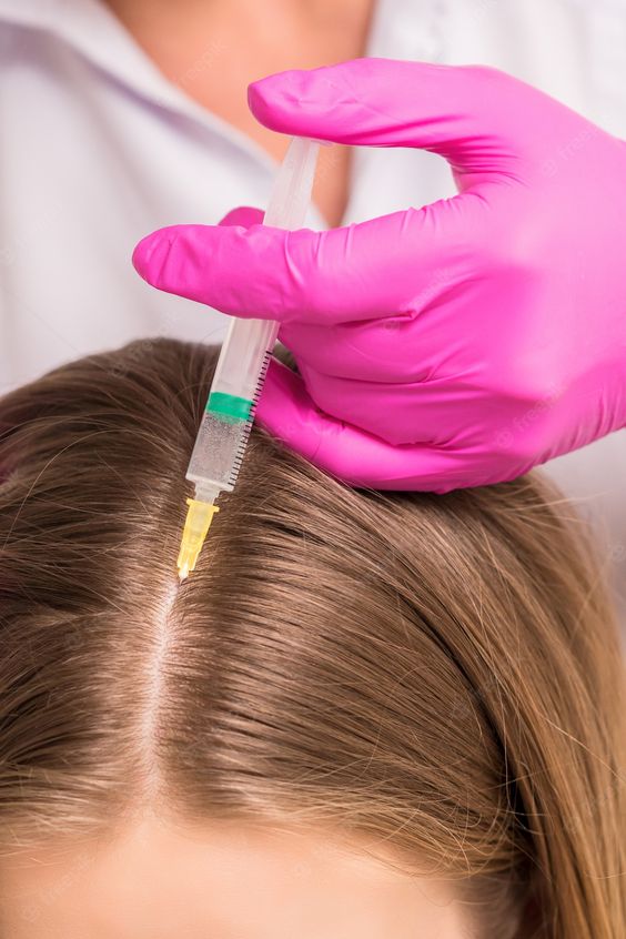 mesoterapia capilar: ¿una nueva forma de lograr un cabello sano y fuerte?